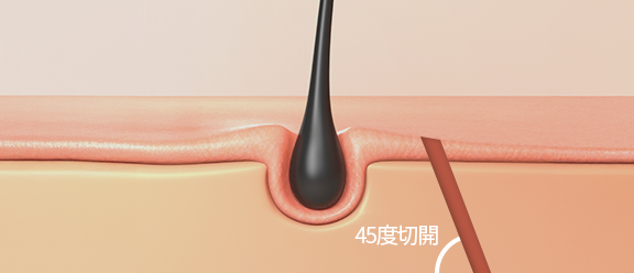 毛根45度切開