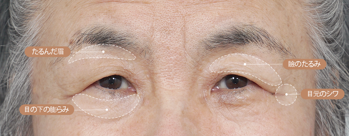 중년 눈성형
