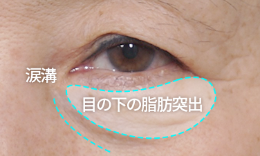 目の下の脂肪