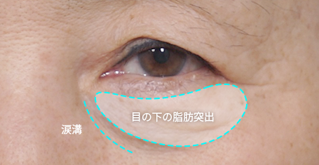 目の下の脂肪