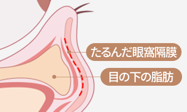 隔膜強化