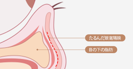 隔膜強化